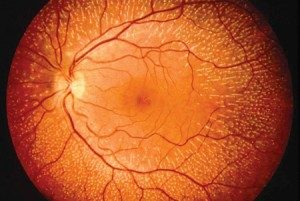 software para diagnosticar enfermedades a traves de la retina 300x201